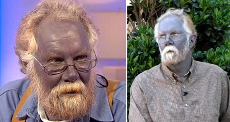 colloidal silver man who turned blue colloidal silver man who turned blue