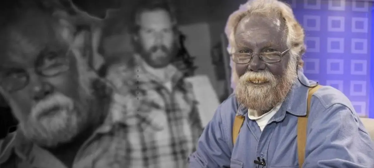 Blue Skin People Blue Skinned Forest Silver Kentucky