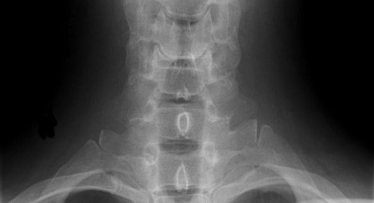 curvature of the spine