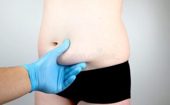 abdominoplasty