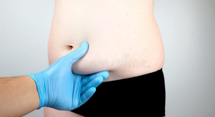 abdominoplasty