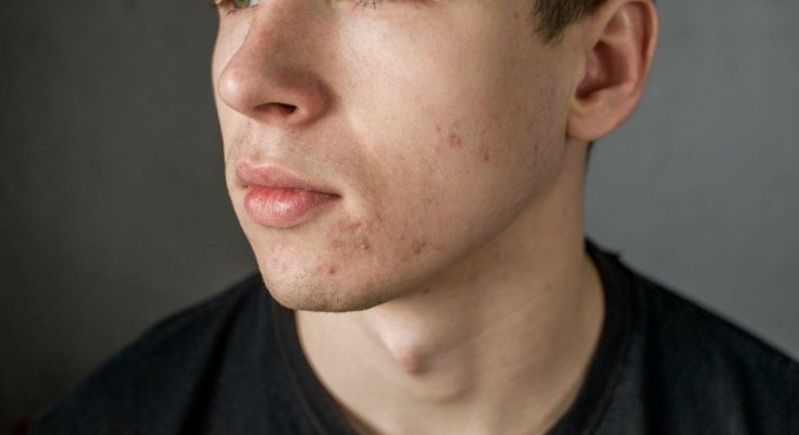4 Surprising Things You Might Not Know About Acne