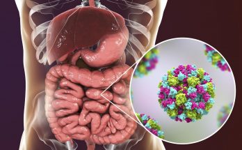 What You Need To Know About Norovirus Infection