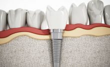 Celebrities Who Have Gotten Dental Implants