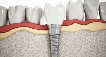 Dental Implants in Santa Monica, CA: Transform Your Smile with Confidence