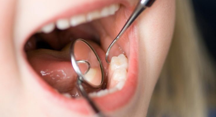 Get Rid of Dental Plaque