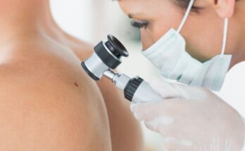 Skin Tumors: Medical Surgeries for Skin Cancer