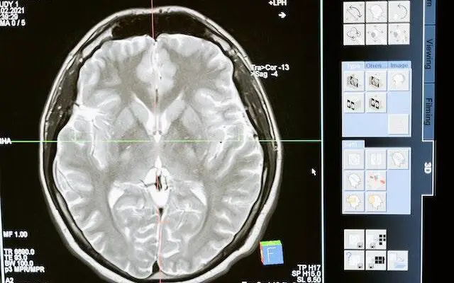 White Matter & Its Role in Physical Disabilities