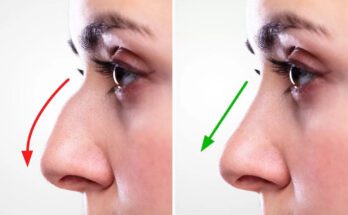 Rhinoplasty in Dubai