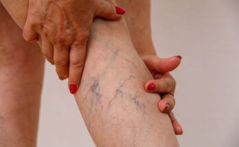 Varicose Veins