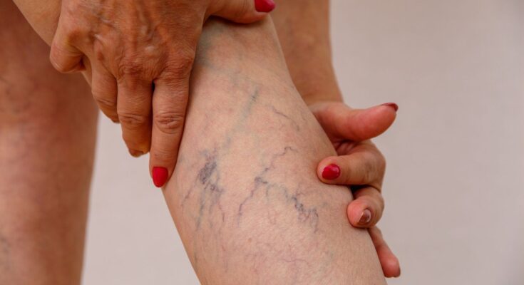 Varicose Veins