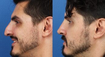 The Rise of Rhinoplasty Among Men