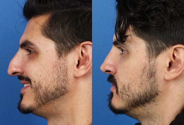 Rise of Rhinoplasty Among Men