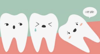 The Truth About Third Molars: What You Need to Know