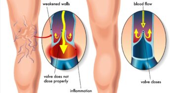 Understanding Venous Health: A Comprehensive Guide