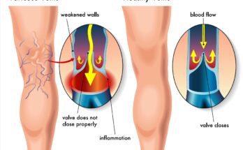 Understanding Venous Health