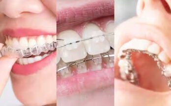 Dr. Aashish Mathesul: Pune's Leading Orthodontist for Invisalign Aligners