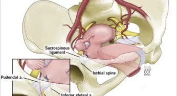 Pelvic Prolapse Surgery: What You Need To Know