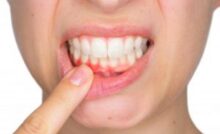 Early Signs of Gum Trouble