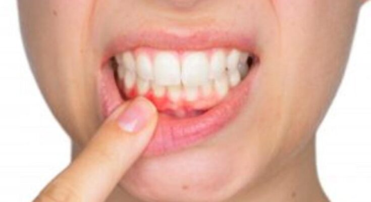 Early Signs of Gum Trouble