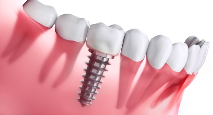 Tooth Implant Dentists